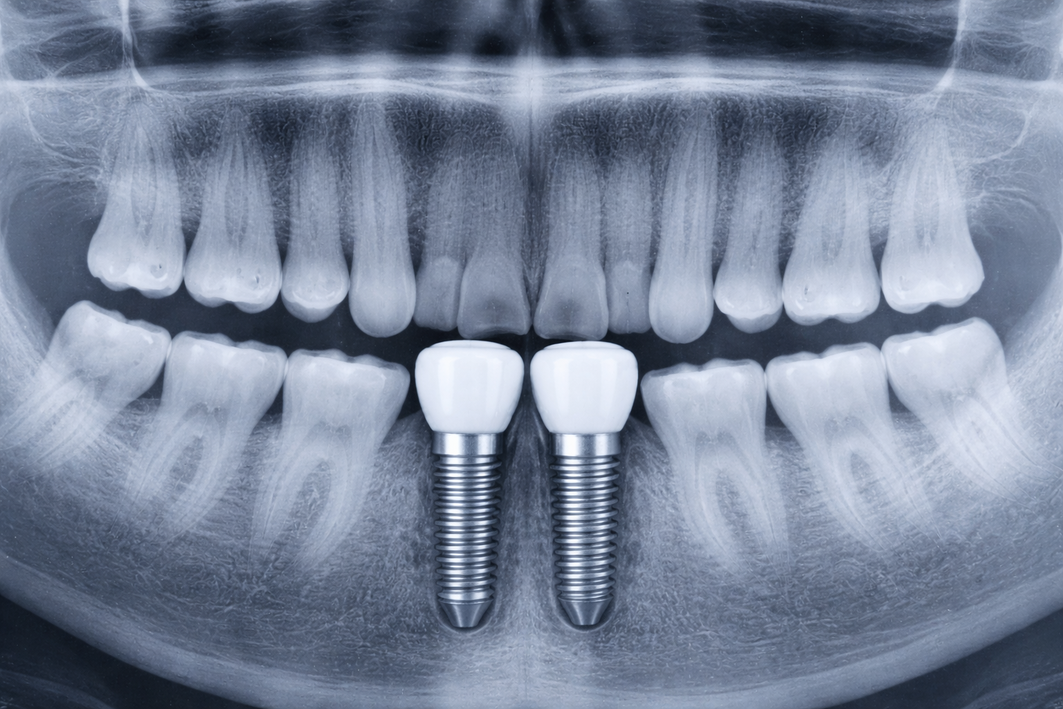 root-canal-treatment-hamilton-family-dental-1